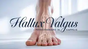 Hallux valgus des großen Zehs