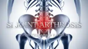 Sakroiliakalgelenk-Arthrose