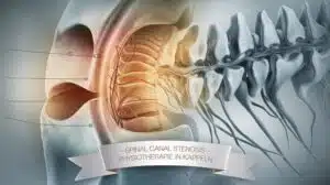 Spinalkanalverengung